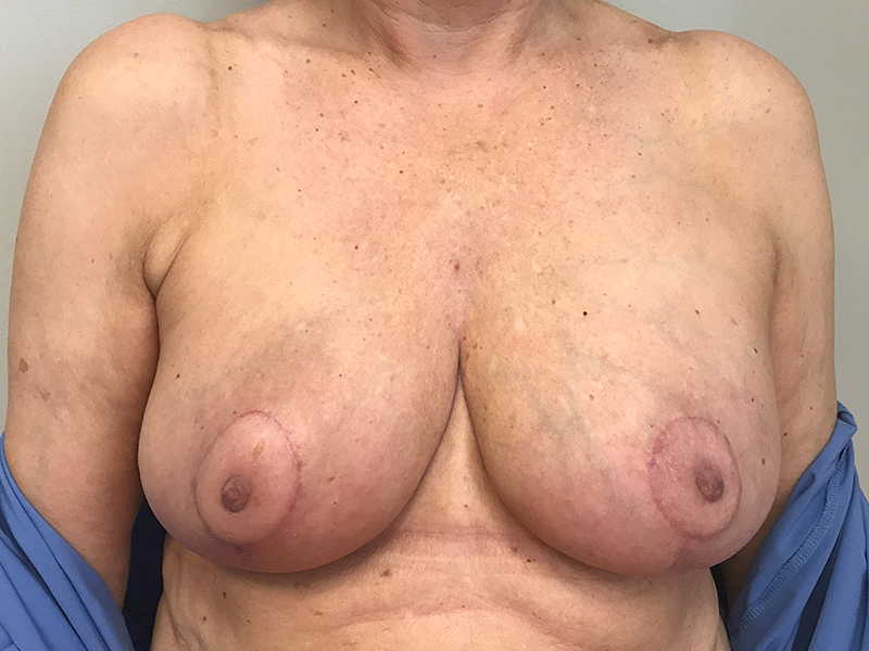 Breast Reduction Before and After | Dr. Nadeau - Plastic and Reconstructive Surgeon