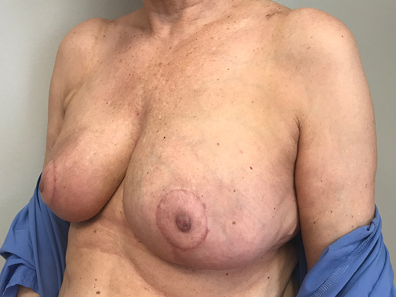 Breast Reduction Before and After | Dr. Nadeau - Plastic and Reconstructive Surgeon