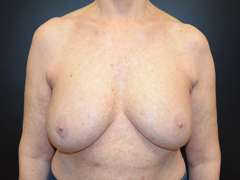 Breast Reduction Before and After | Dr. Nadeau - Plastic and Reconstructive Surgeon
