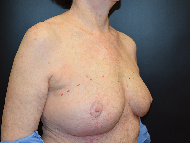 Breast Reduction Before and After | Dr. Nadeau - Plastic and Reconstructive Surgeon