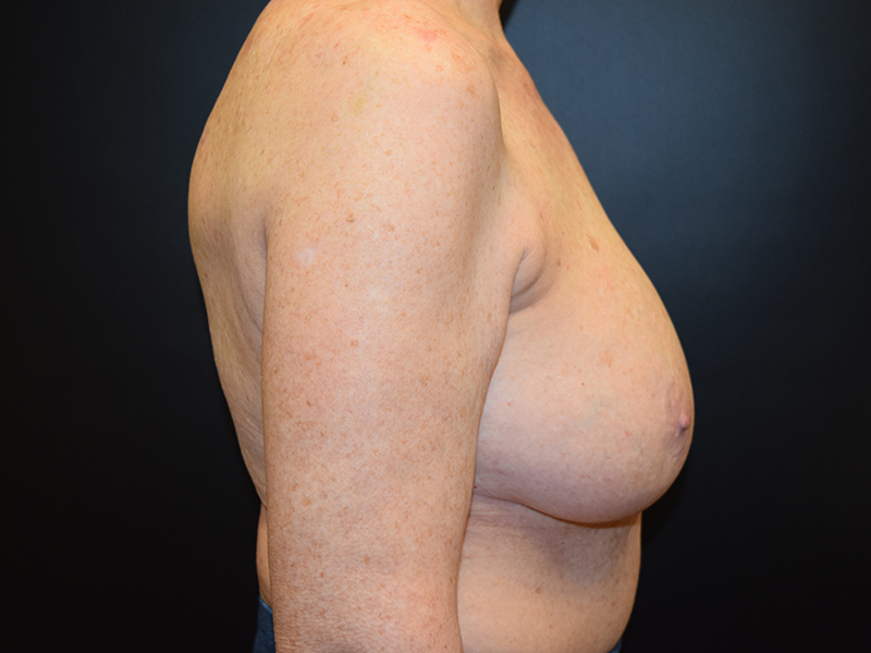 Breast Reduction Before and After | Dr. Nadeau - Plastic and Reconstructive Surgeon