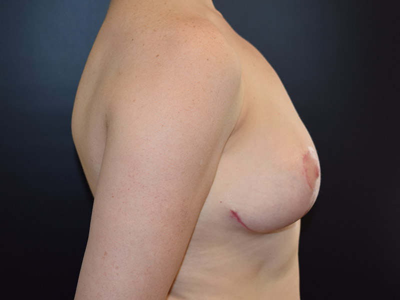 Breast Reduction Before and After | Dr. Nadeau - Plastic and Reconstructive Surgeon