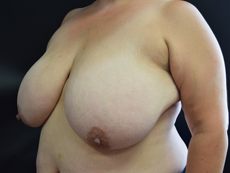 Breast Reduction Before and After | Dr. Nadeau - Plastic and Reconstructive Surgeon