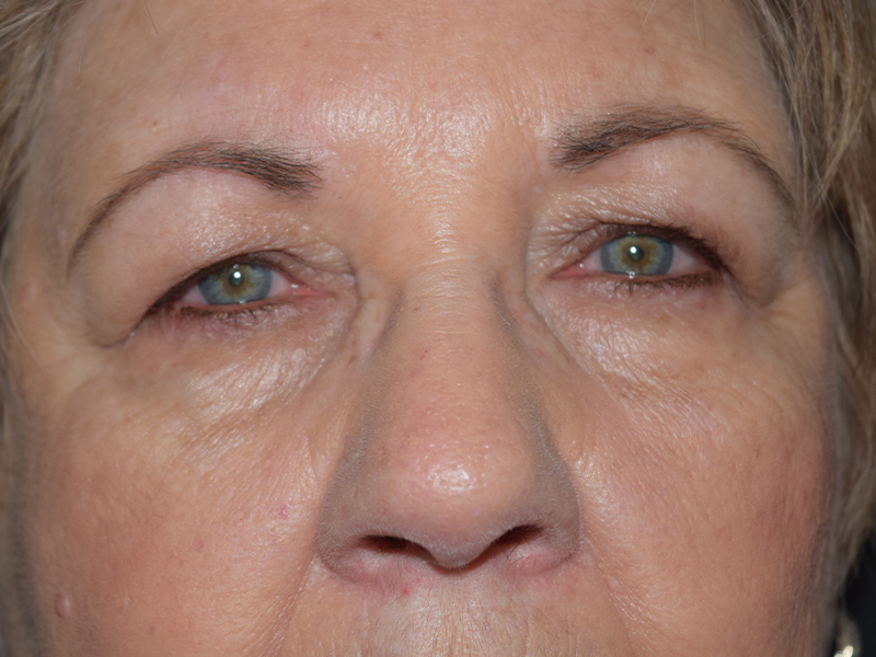Brow Lift Before and After | Dr. Nadeau - Plastic and Reconstructive Surgeon