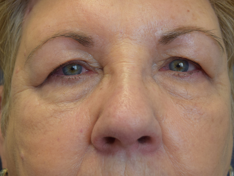 Brow Lift Before and After | Dr. Nadeau - Plastic and Reconstructive Surgeon