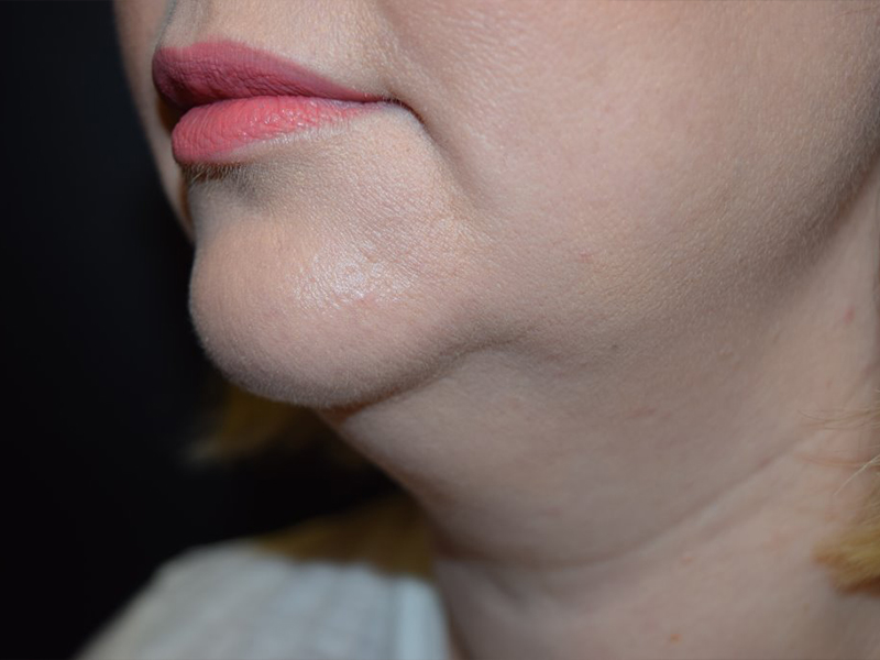 Chin And Cheek Augmentation Before and After | Dr. Nadeau - Plastic and Reconstructive Surgeon