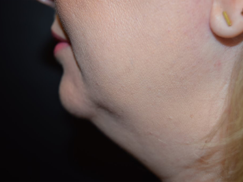 Chin And Cheek Augmentation Before and After | Dr. Nadeau - Plastic and Reconstructive Surgeon