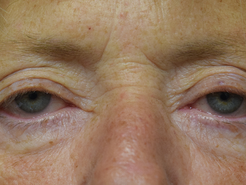 Before and After Eyelid Surgery in Seattle