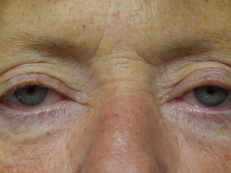 Eyelid Surgery Before and After | Dr. Nadeau - Plastic and Reconstructive Surgeon