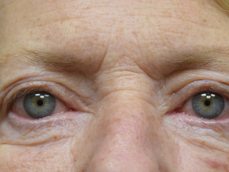 Blepharoplasty Bellevue - Eyelid Surgery Seattle