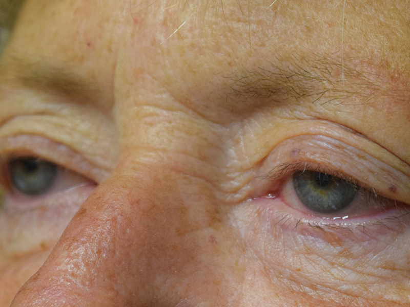 Eyelid Surgery Before and After | Dr. Nadeau - Plastic and Reconstructive Surgeon