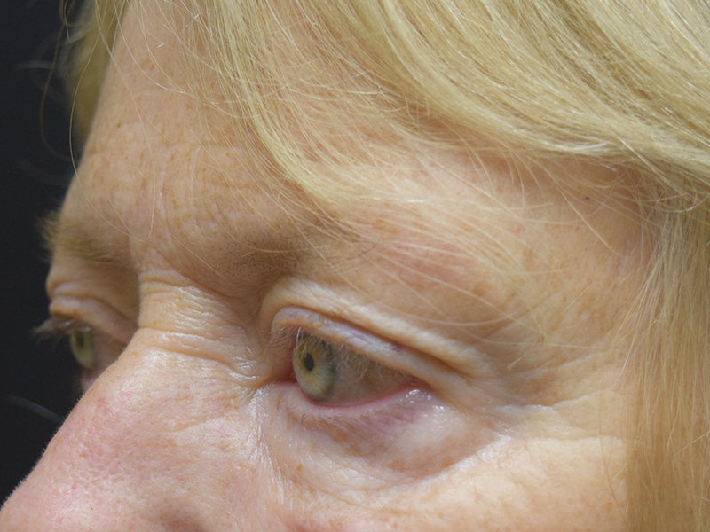 Eyelid Surgery Before and After | Dr. Nadeau - Plastic and Reconstructive Surgeon