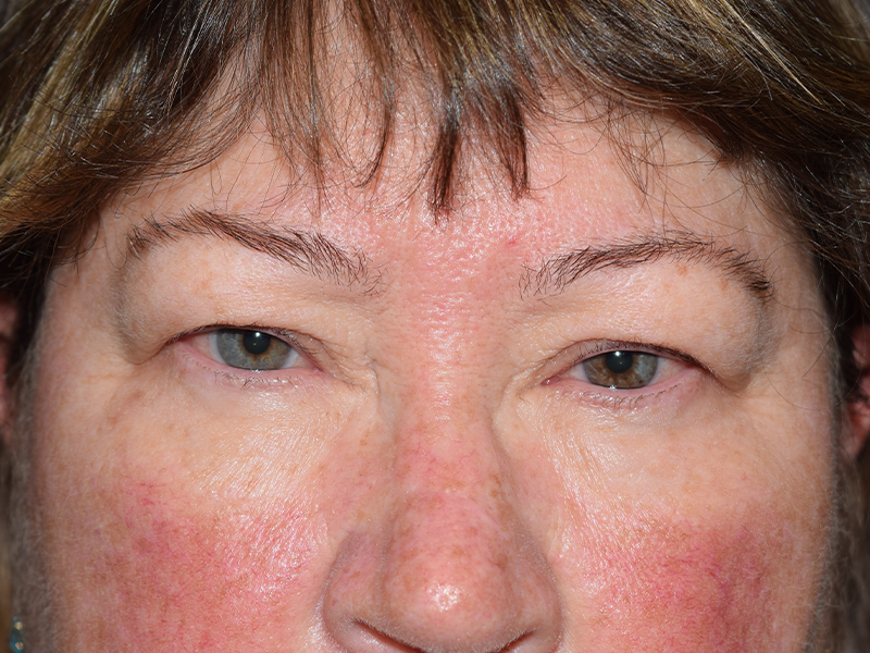 Before Eyelid Surgery in Seattle