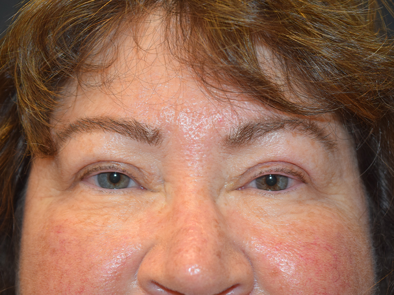 After Eyelid Surgery in Seattle