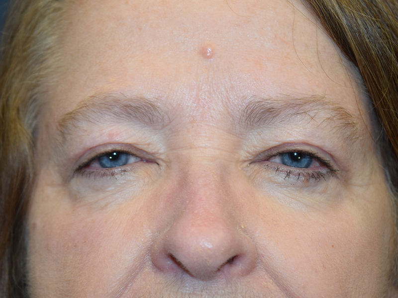 Eyelid Surgery Before and After | Dr. Nadeau - Plastic and Reconstructive Surgeon