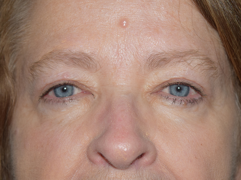 After Photo of Blepharoplasty in Seattle