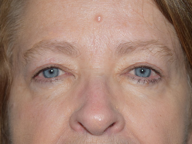 Eyelid Surgery Before and After | Dr. Nadeau - Plastic and Reconstructive Surgeon