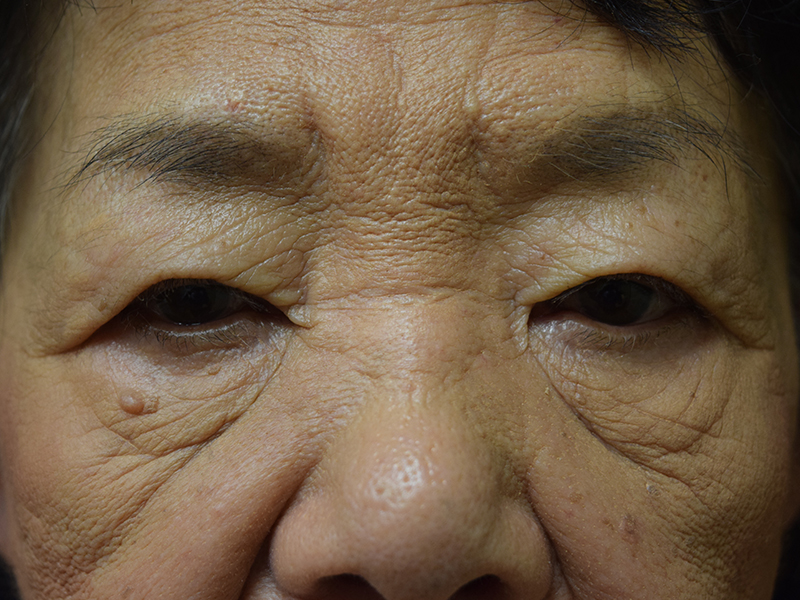 Before and After Blepharoplasty in Seattle