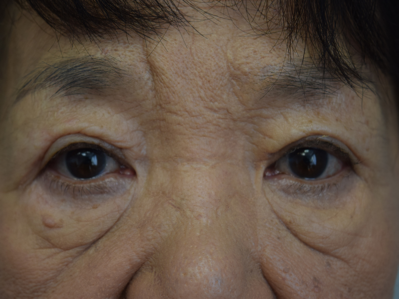 Eyelid Surgery Before and After | Dr. Nadeau - Plastic and Reconstructive Surgeon