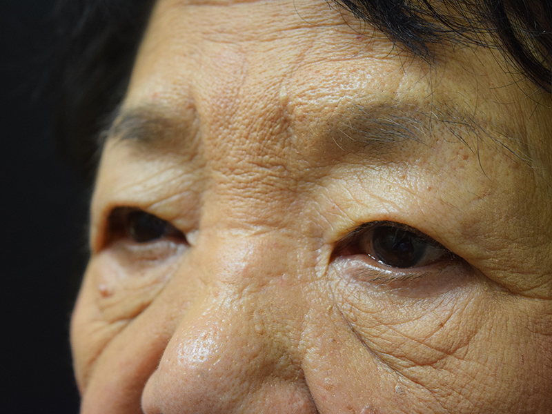 Eyelid Surgery Before and After | Dr. Nadeau - Plastic and Reconstructive Surgeon