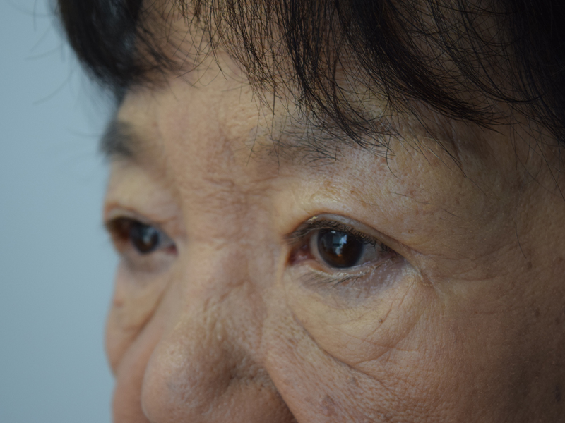 Eyelid Surgery Before and After | Dr. Nadeau - Plastic and Reconstructive Surgeon