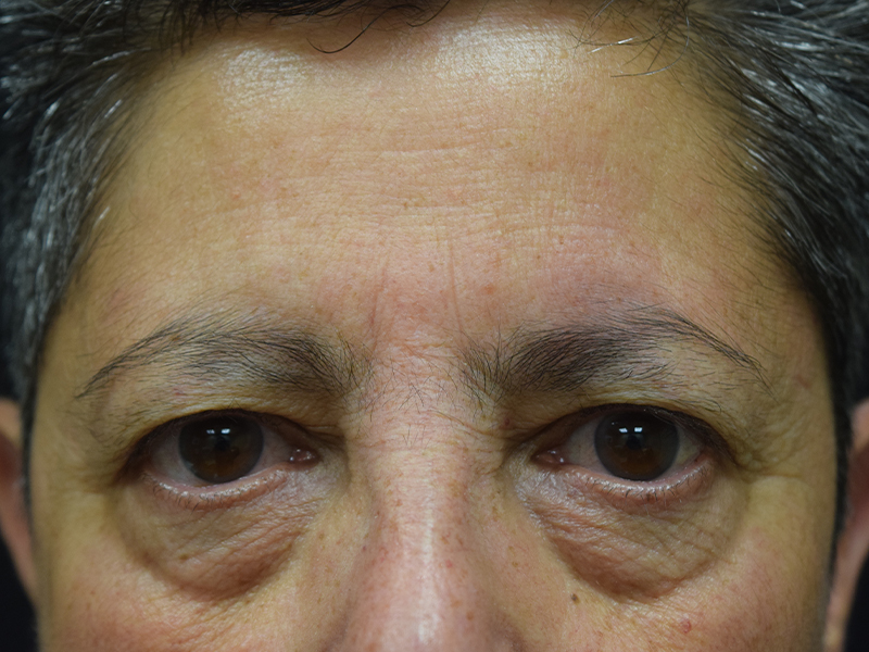 Before and After Eyelid Surgery in Seattle