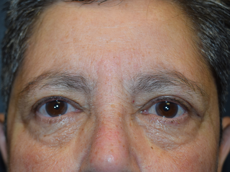 Before and After Eyelid Surgery in Seattle