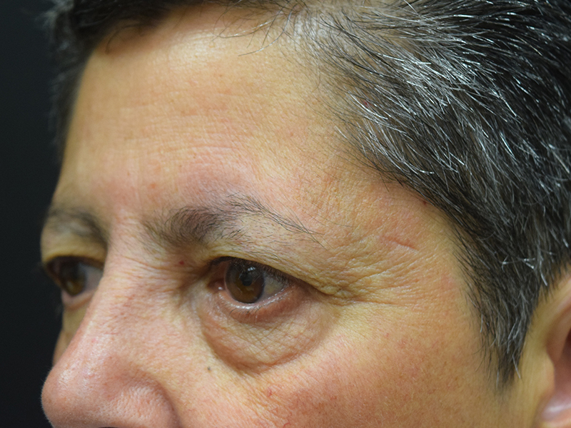 Eyelid Surgery Before and After | Dr. Nadeau - Plastic and Reconstructive Surgeon