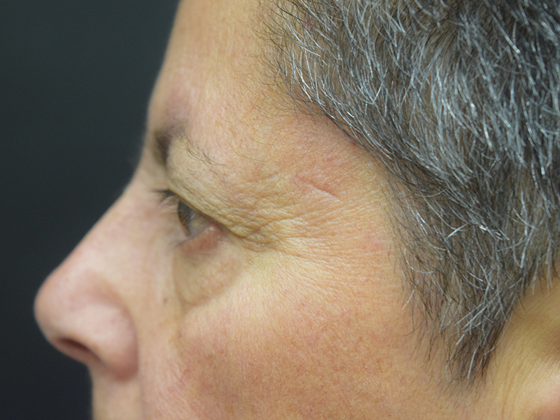 Eyelid Surgery Before and After | Dr. Nadeau - Plastic and Reconstructive Surgeon