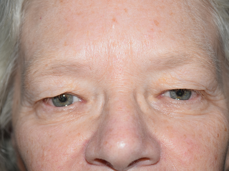 Before and After Blepharoplasty in Seattle