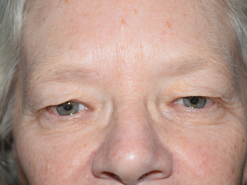 Eyelid Surgery Before and After | Dr. Nadeau - Plastic and Reconstructive Surgeon