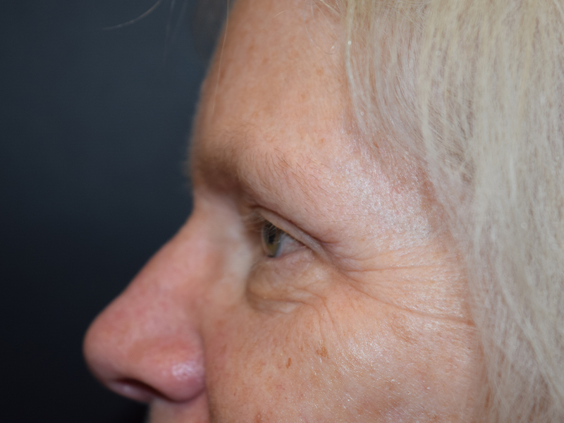 Eyelid Surgery Before and After | Dr. Nadeau - Plastic and Reconstructive Surgeon