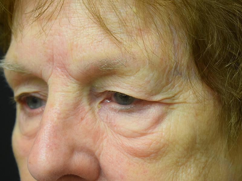 Eyelid Surgery Before and After | Dr. Nadeau - Plastic and Reconstructive Surgeon