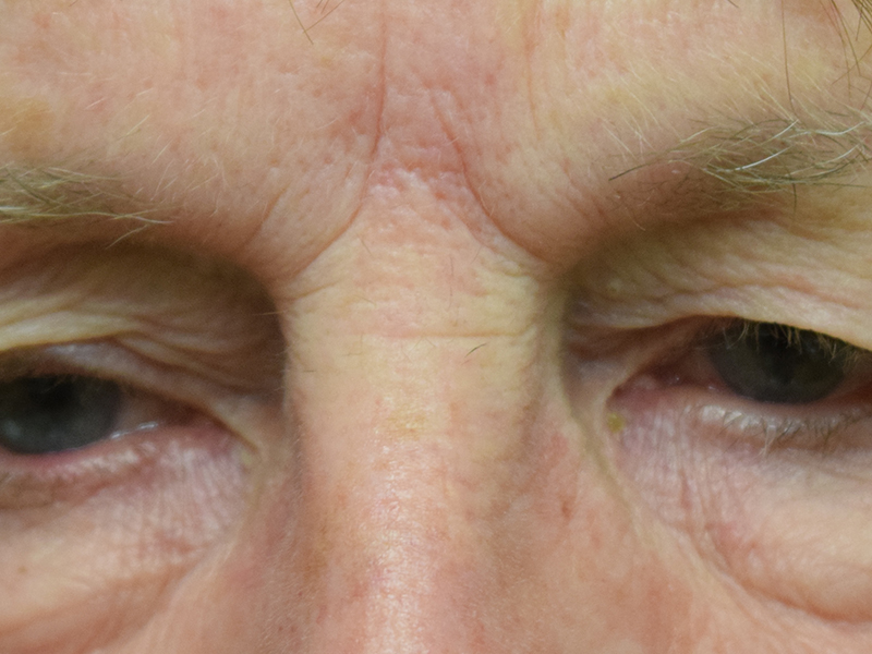 Eyelid Surgery Before and After | Dr. Nadeau - Plastic and Reconstructive Surgeon