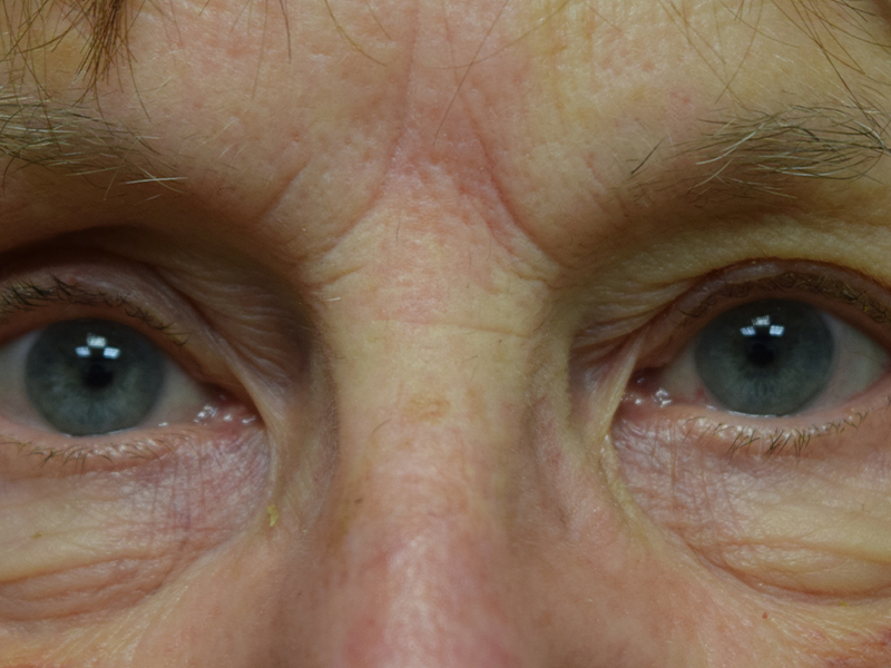 Eyelid Surgery Before and After | Dr. Nadeau - Plastic and Reconstructive Surgeon