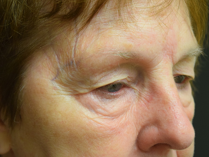 Eyelid Surgery Before and After | Dr. Nadeau - Plastic and Reconstructive Surgeon