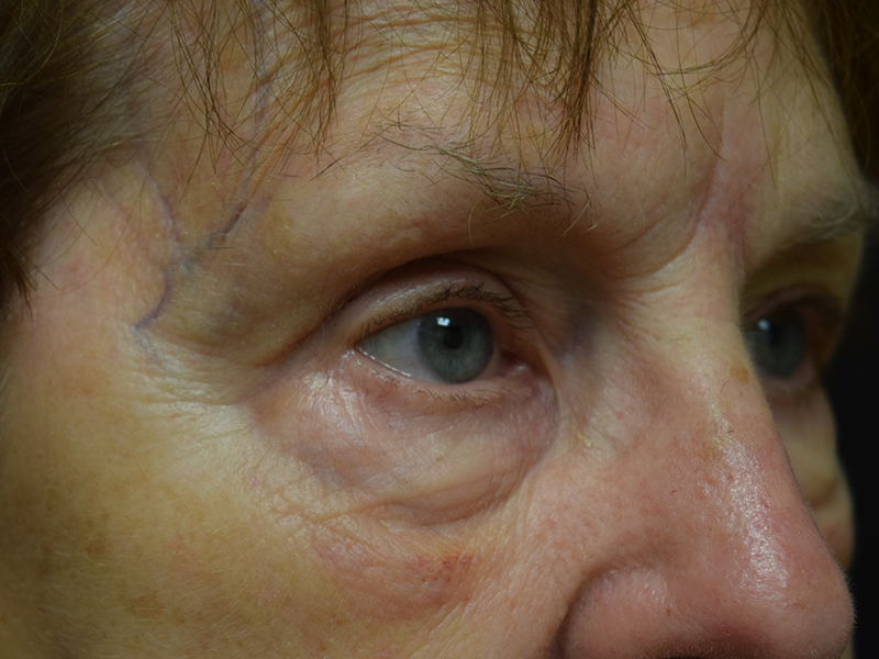 Eyelid Surgery Before and After | Dr. Nadeau - Plastic and Reconstructive Surgeon