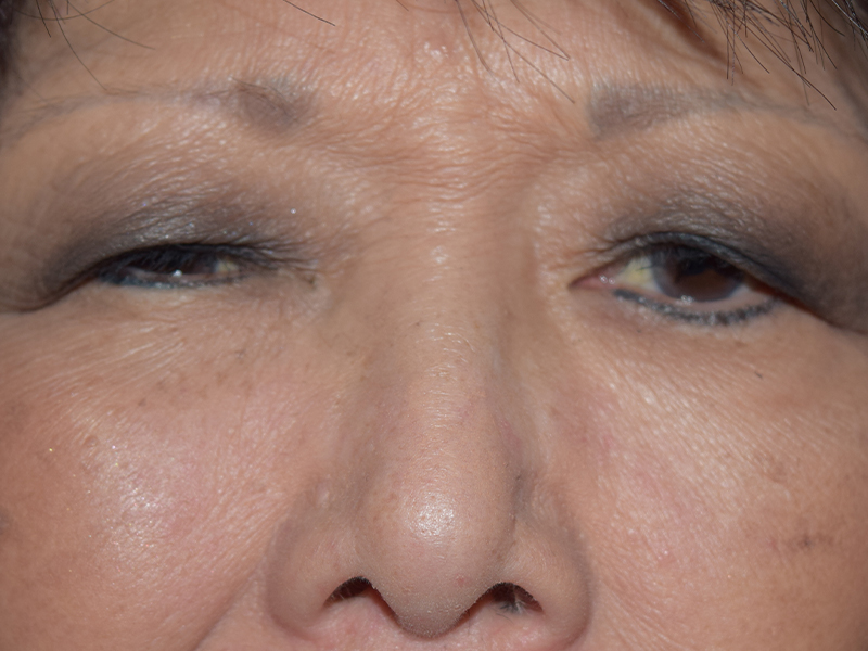 Eyelid Surgery Before and After | Dr. Nadeau - Plastic and Reconstructive Surgeon