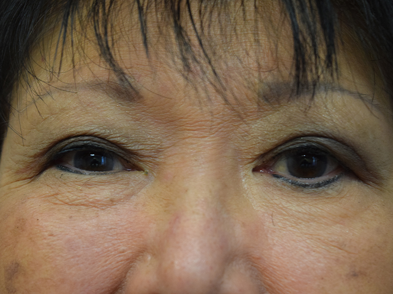 Eyelid Surgery Before and After | Dr. Nadeau - Plastic and Reconstructive Surgeon