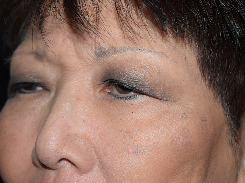 Eyelid Surgery Before and After | Dr. Nadeau - Plastic and Reconstructive Surgeon