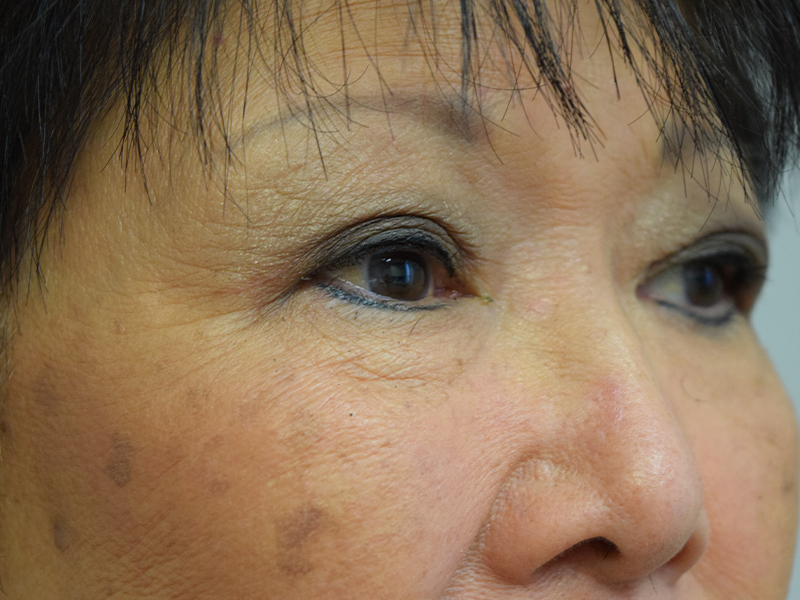 Eyelid Surgery Before and After | Dr. Nadeau - Plastic and Reconstructive Surgeon