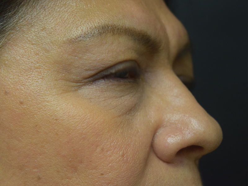 Eyelid Surgery Before and After | Dr. Nadeau - Plastic and Reconstructive Surgeon