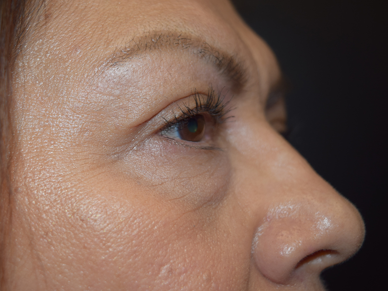 Eyelid Surgery Before and After | Dr. Nadeau - Plastic and Reconstructive Surgeon