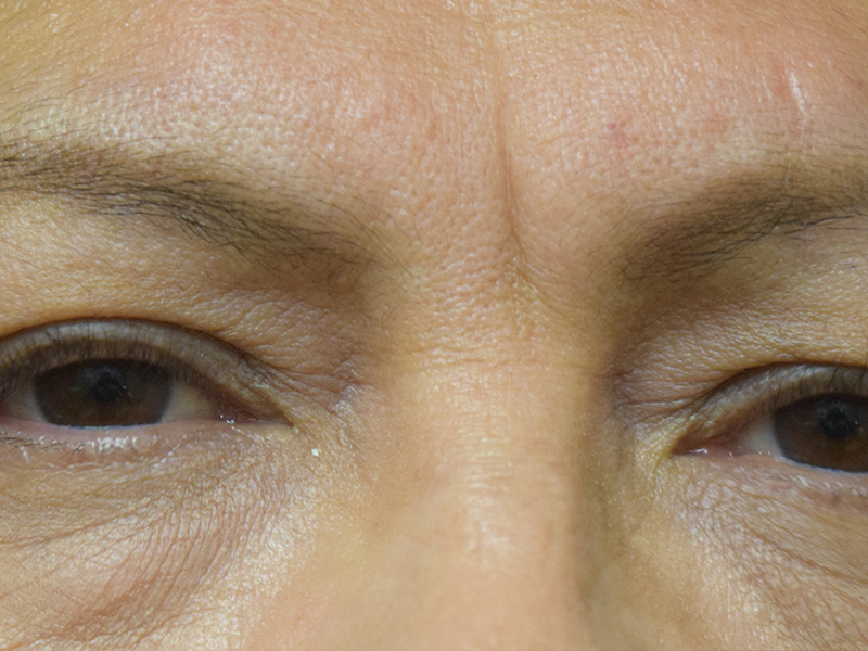 Eyelid Surgery Before and After | Dr. Nadeau - Plastic and Reconstructive Surgeon