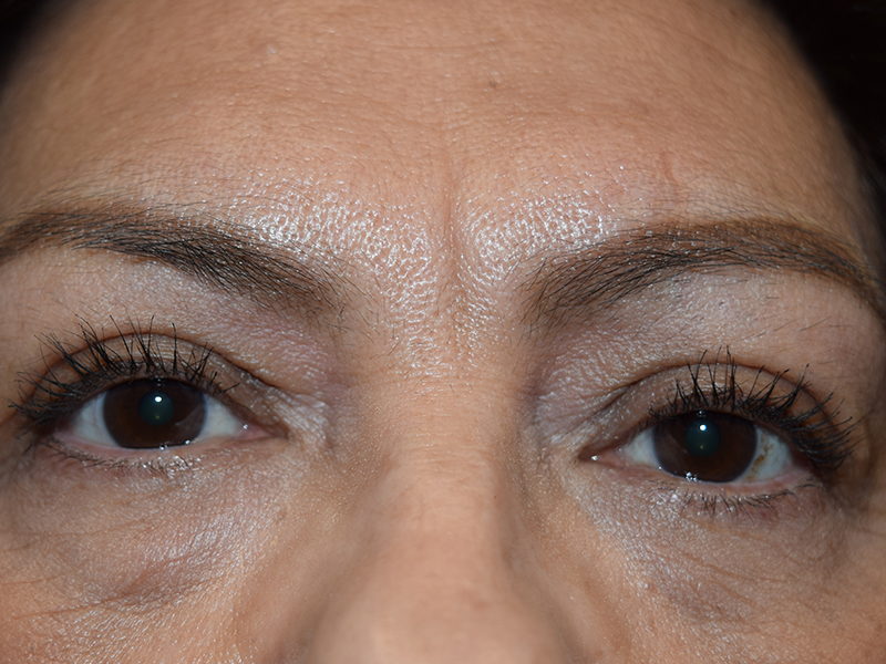 Eyelid Surgery Before and After | Dr. Nadeau - Plastic and Reconstructive Surgeon