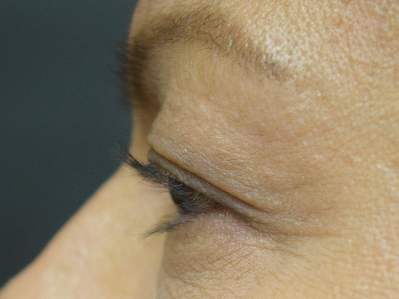 Eyelid Surgery Before and After | Dr. Nadeau - Plastic and Reconstructive Surgeon