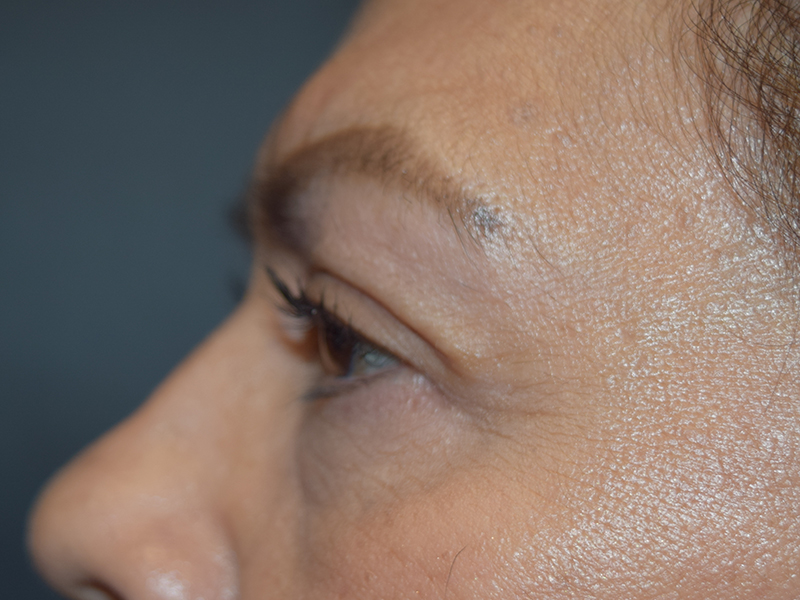 Eyelid Surgery Before and After | Dr. Nadeau - Plastic and Reconstructive Surgeon