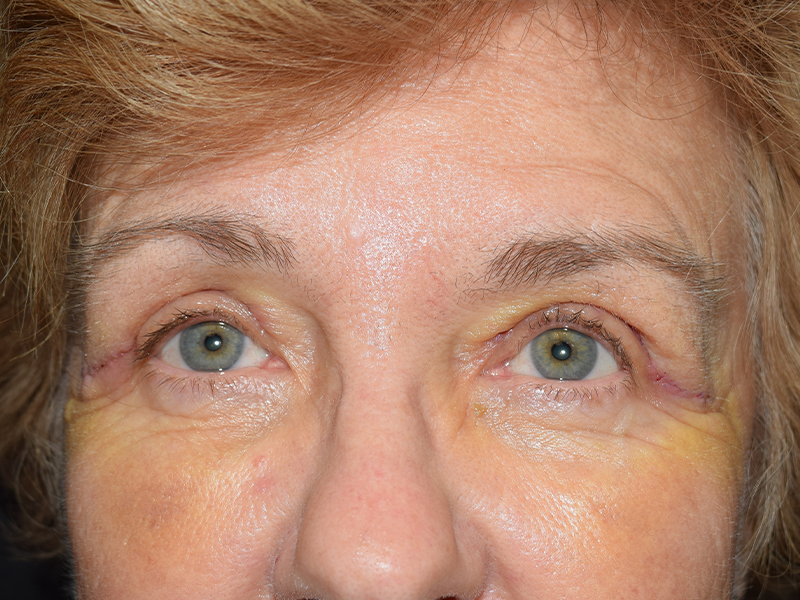 Eyelid Surgery Before and After | Dr. Nadeau - Plastic and Reconstructive Surgeon