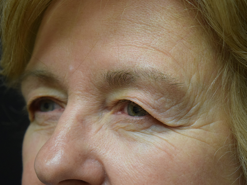 Eyelid Surgery Before and After | Dr. Nadeau - Plastic and Reconstructive Surgeon