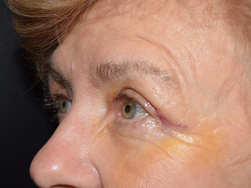 Eyelid Surgery Before and After | Dr. Nadeau - Plastic and Reconstructive Surgeon